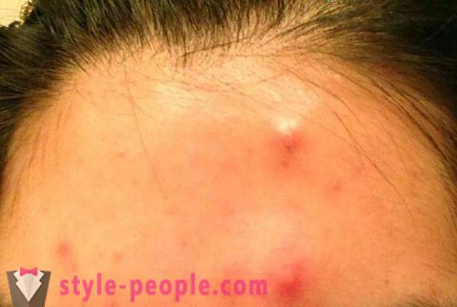 Per quanto riguarda la notte per sbarazzarsi di acne a casa?