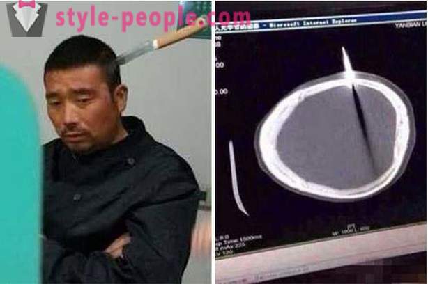 Un uomo cinese con un coltello nella sua testa è andato al medico