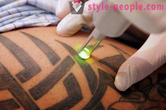 Rimozione del tatuaggio laser. Inviato il