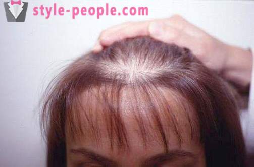 Capelli Darsonval. darsonvalya Applicazione per il trattamento e la prevenzione della perdita dei capelli