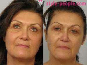 Laser resurfacing del viso - un modo sicuro per ringiovanire