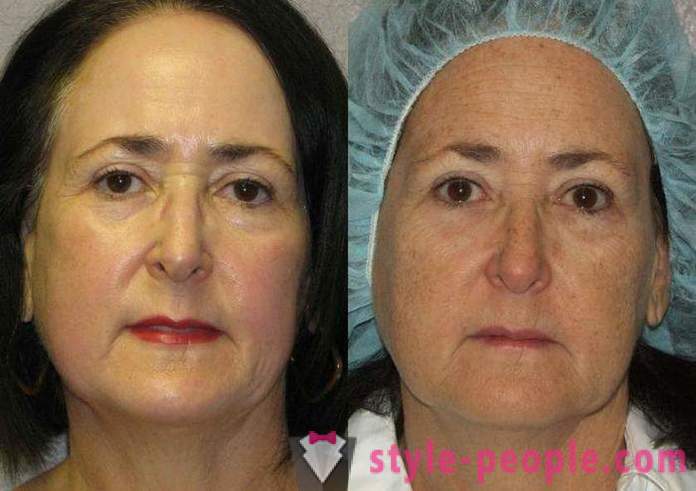 Laser resurfacing del viso - un modo sicuro per ringiovanire